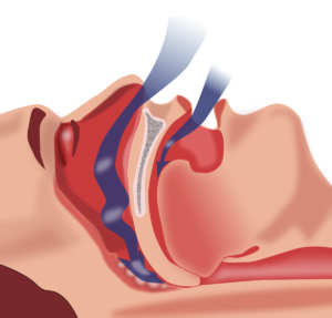 Apnea Notturna