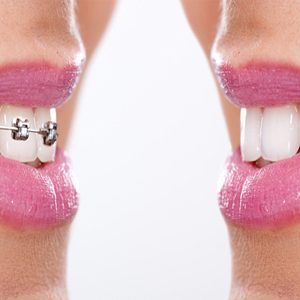 allineamento denti anteprima