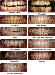 cibi che macchiano i denti