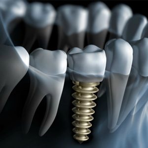 Osseointegration and the duration of a dental implant -thumbnail