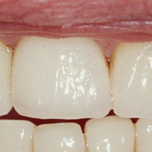 zirconio dentale anteprima
