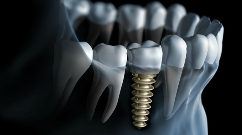 Osseointegration And The Duration Of A Dental Implant 4680