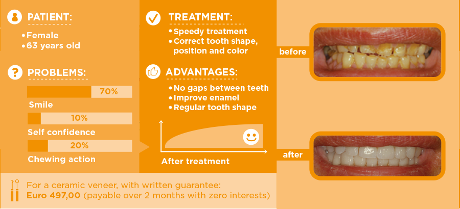 Differences between Veneers and Lumineers dental veneers - Estetica Dentale  a Roma