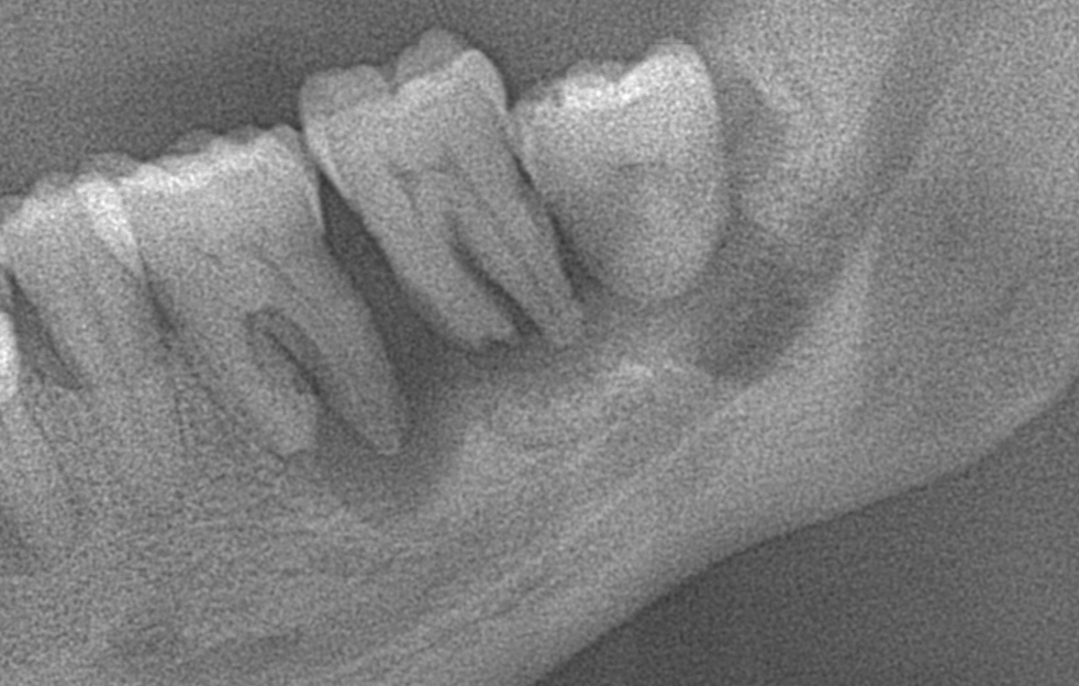 La Corona Dentale cosa è? - Dr. Paola Del Bianco