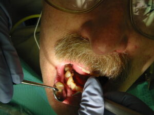 gum periodontitis gum periodontitis