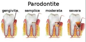 gum periodontitis