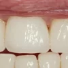 dental-zirconium