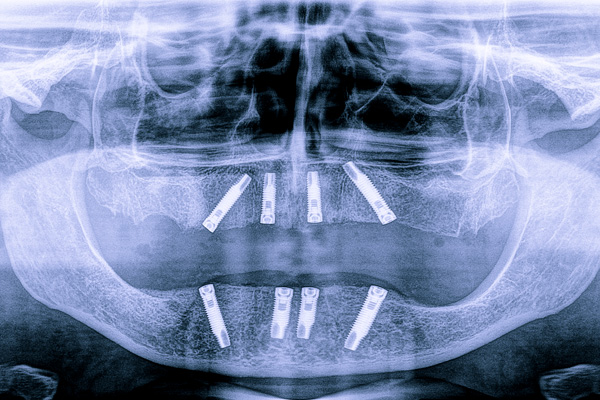 FreeSmile Roma Srl - Lastra TOP